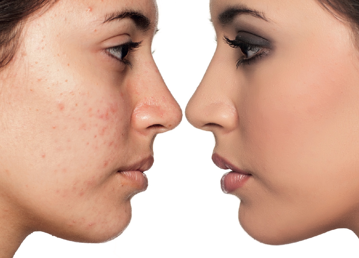 Les causes de l'augmentation de l'acné